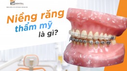 Niềng răng thẩm mỹ là gì? Chi phí bao nhiêu?