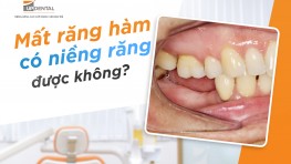 Mất răng hàm có niềng răng được không?