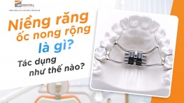 Niềng răng ốc nong rộng là gì? Tác dụng như thế nào?