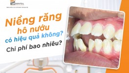Niềng răng hô nướu có hiệu quả không? Chi phí bao nhiêu?