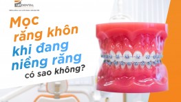 Mọc răng khôn khi đang niềng răng có sao không?
