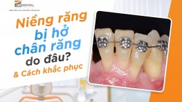 Niềng răng bị hở chân răng do đâu, cách khắc phục?