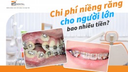 Chi phí niềng răng cho người lớn bao nhiêu tiền ? 