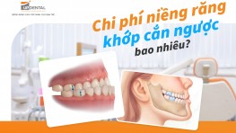 Chi phí niềng răng khớp cắn ngược bao nhiêu? 