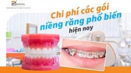 Chi phí các gói niềng răng phổ biến hiện nay tại Up Dental