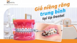 Giá niềng răng trung bình tại Up Dental [năm 2024]