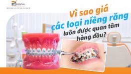 Vì sao giá các loại niềng răng luôn được quan tâm hàng đầu?