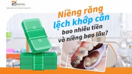 Niềng răng lệch khớp cắn bao nhiêu tiền và niềng bao lâu?