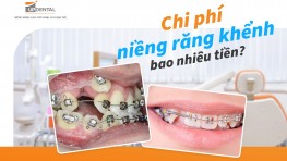 Chi phí niềng răng khểnh bao nhiêu tiền?