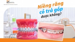 Niềng răng có trả góp được không? [Giải đáp thắc mắc]