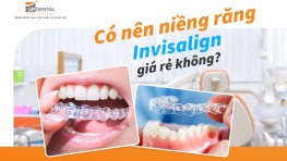 Có nên niềng răng Invisalign giá rẻ không?