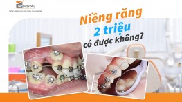 Niềng răng 2 triệu có được không? [Giải đáp thắc mắc]