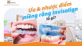 Ưu điểm và nhược điểm của niềng răng Invisalign là gì?