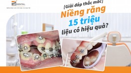 [Giải đáp thắc mắc] Niềng răng 15 triệu liệu có hiệu quả?