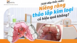 [Giải đáp] Niềng răng tháo lắp kim loại có hiệu quả không?