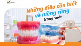 Niềng răng trong suốt là gì? Những điều cần biết