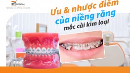 Ưu điểm và nhược điểm của niềng răng mắc cài kim loại