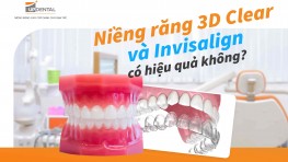 Niềng răng 3D Clear và Invisalign có hiệu quả không?