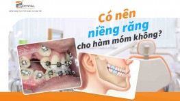 Có nên niềng răng cho hàm móm không? [Giải đáp]