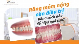 Răng móm nặng nên điều trị bằng cách nào để hiệu quả cao?