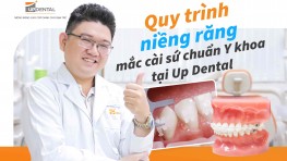 Quy trình niềng răng mắc cài sứ chuẩn Y khoa tại Up Dental