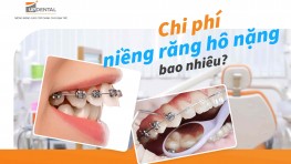 Chi phí niềng răng hô nặng bao nhiêu?