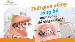 Thời gian niềng răng hô mất bao lâu thì răng sẽ đẹp?