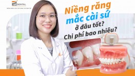 Niềng răng mắc cài sứ ở đâu tốt? Chi phí bao nhiêu?