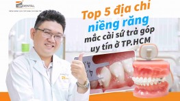 Top 5 địa chỉ niềng răng mắc cài sứ trả góp uy tín ở TP.HCM