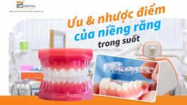 Ưu điểm và nhược điểm của niềng răng trong suốt