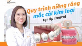 Quy trình niềng răng mắc cài kim loại tại Up Dental