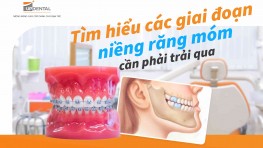 Tìm hiểu các giai đoạn niềng răng móm cần phải trải qua