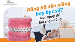 Răng hô nên niềng hay bọc sứ? Đọc ngay để lựa chọn đúng