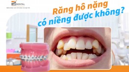 Răng hô nặng có niềng được không? [Giải đáp]