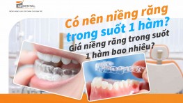 Có nên niềng răng trong suốt 1 hàm? Giá niềng răng trong suốt 1 hàm bao nhiêu?