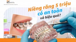 Niềng răng 5 triệu có an toàn và hiệu quả?