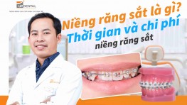 Niềng răng sắt là gì? Thời gian và chi phí niềng răng sắt