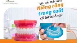 Niềng răng trong suốt có tốt không? [Giải đáp thắc mắc]