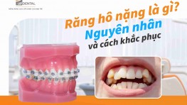 Răng hô nặng là gì? Nguyên nhân và cách khắc phục