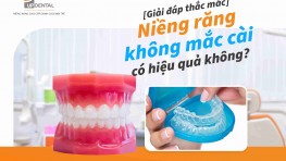 Niềng răng không mắc cài có hiệu quả không? [Giải đáp]