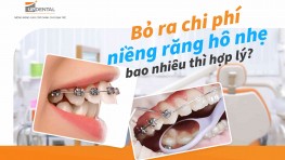 Bỏ ra chi phí niềng răng hô nhẹ bao nhiêu thì hợp lý?