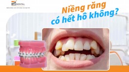 Niềng răng có hết hô không? [Chuyên gia giải đáp]