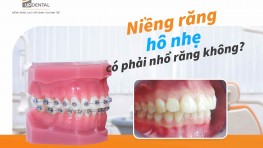 Giải đáp: Niềng răng hô nhẹ có phải nhổ răng không?