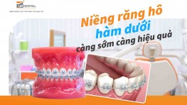 Răng hô hàm dưới - Niềng càng sớm càng hiệu quả