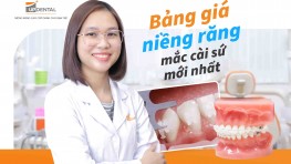 Bảng giá niềng răng mắc cài sứ mới nhất [2026]