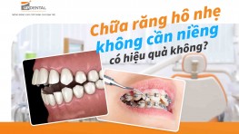 Chữa răng hô nhẹ không cần niềng có hiệu quả không?
