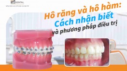  Hô răng và hô hàm: Cách nhận biết và phương pháp điều trị