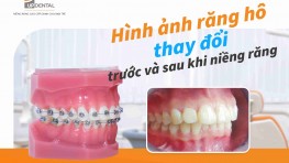 Hình ảnh răng hô thay đổi trước và sau khi niềng răng