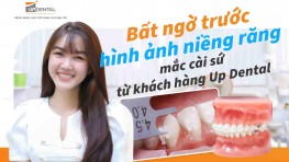 Bất ngờ trước hình ảnh niềng răng mắc cài sứ từ khách hàng Up Dental