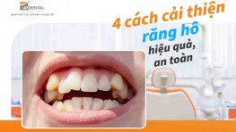 4 cách cải thiện răng hô hiệu quả, an toàn